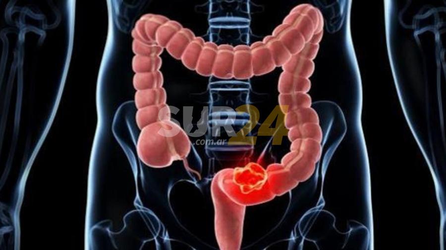 Una dieta poco saludable impacta en el desarrollo del cáncer de colon