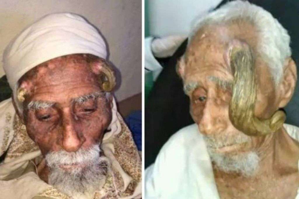 Murió el hombre más viejo del mundo, tras una operación para quitarle los cuernos en la cabeza
