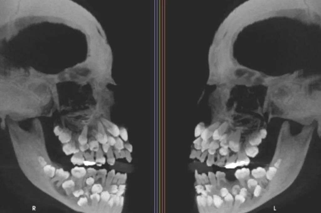 Brasil: una niña con 81 dientes se convirtió en un desafío clínico para los odontólogos