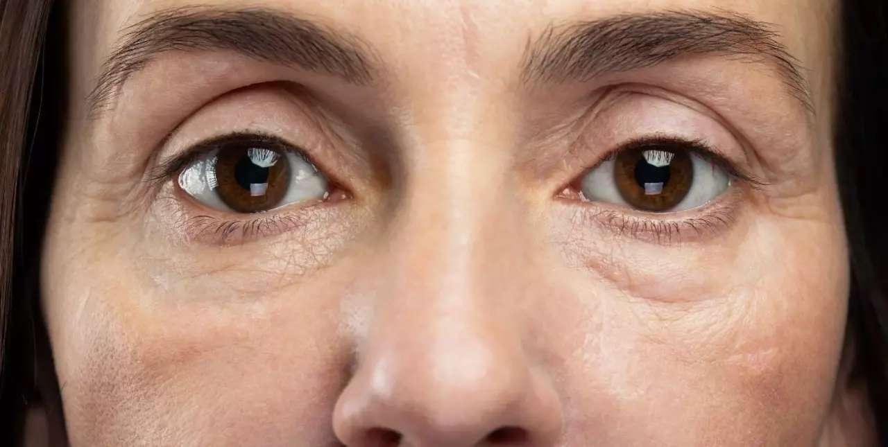 Ojeras: cómo combatirlas y mejorar la apariencia de la piel