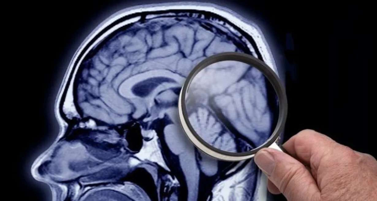 Nuevos fármacos para el Alzheimer: un especialista aclara puntos claves