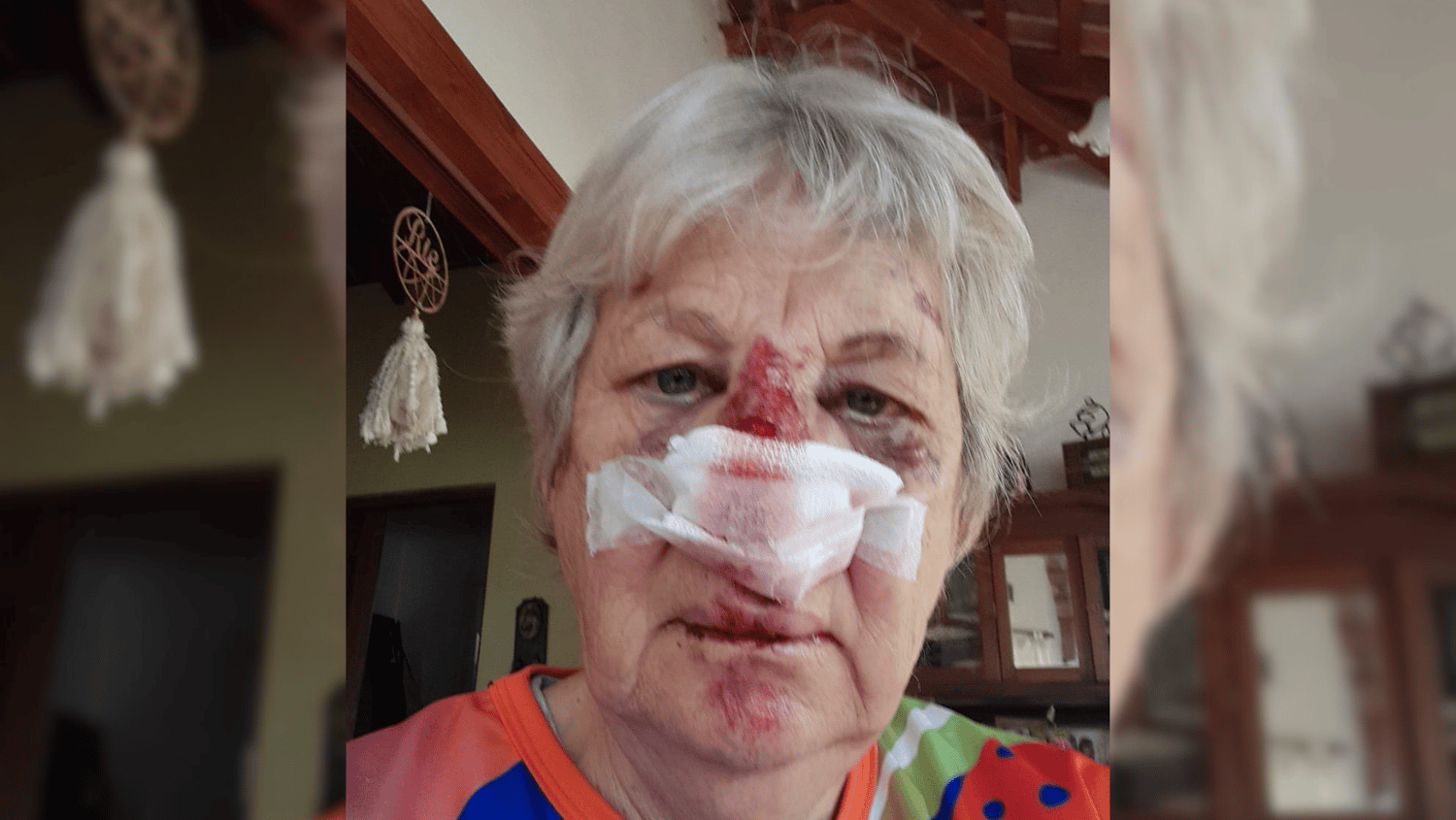 Indignante: por el robo de un equipo de mate una mujer terminó desfigurada