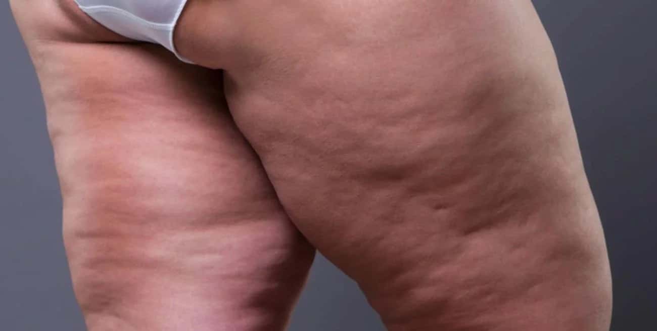 La enfermedad que confunden con celulitis y es más que un problema de “piernas gordas"