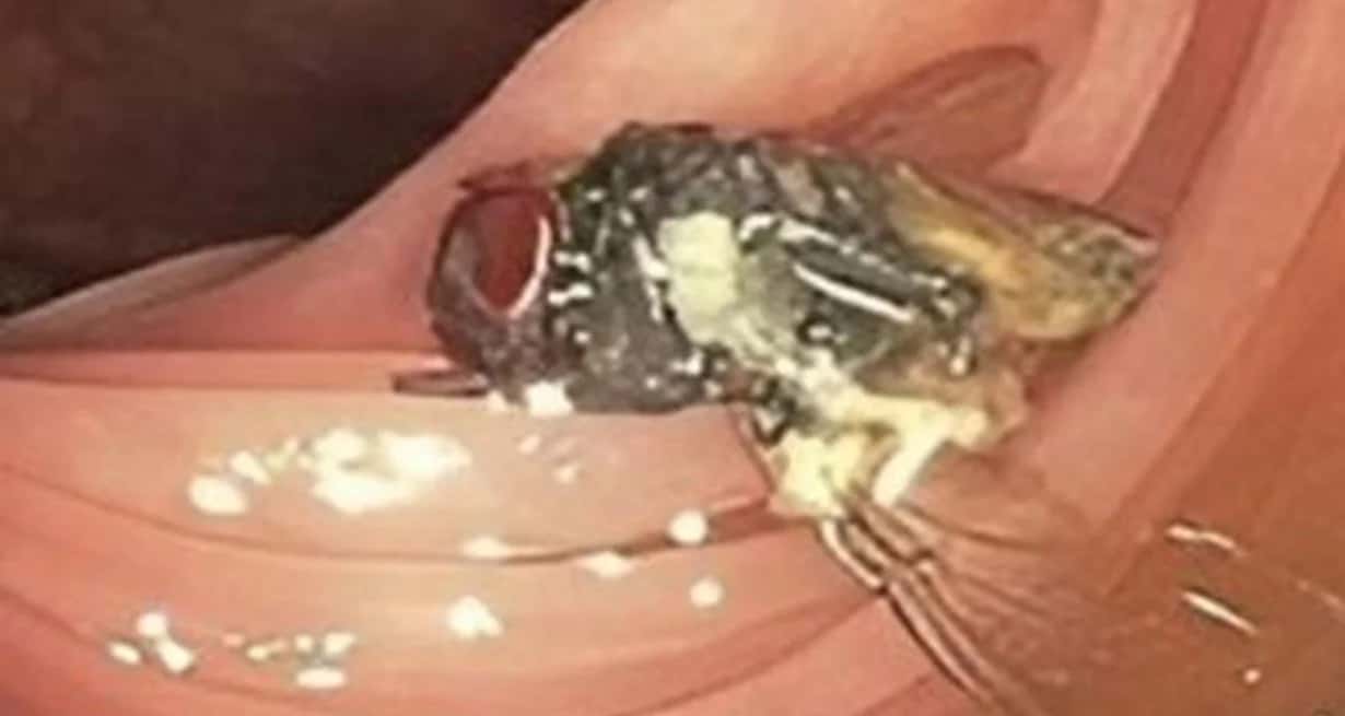 Hallaron una mosca intacta dentro de un paciente durante una colonoscopía