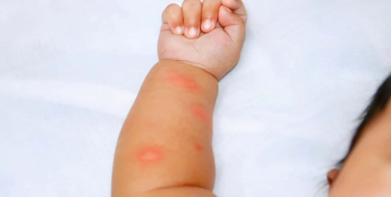 El impacto del dengue en la población infantil: qué se debe tener en cuenta